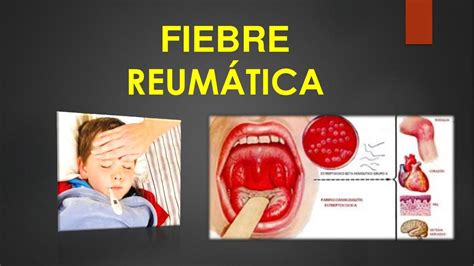 fiebre reumatica - fiebre escarlatina